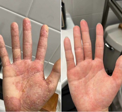 Krema za vnetje kože & Zdrava koža – Pomirja srbenje, rdečico in luščenje 50ml photo review